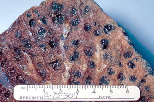 smoker's lung tissue