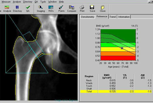 bone density