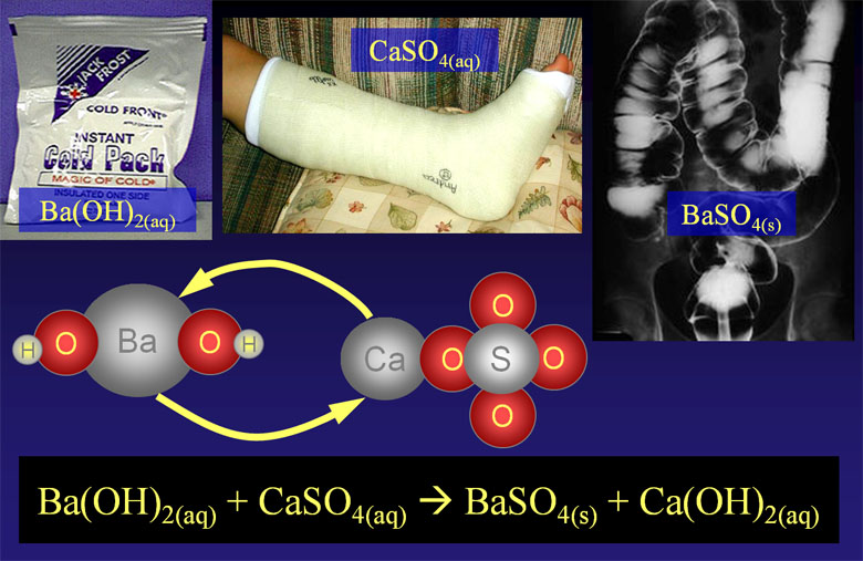 cold pack, leg cast and xray of intestines